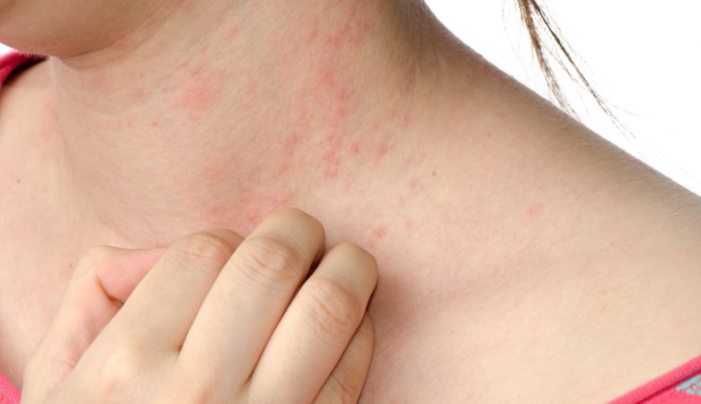 eczema